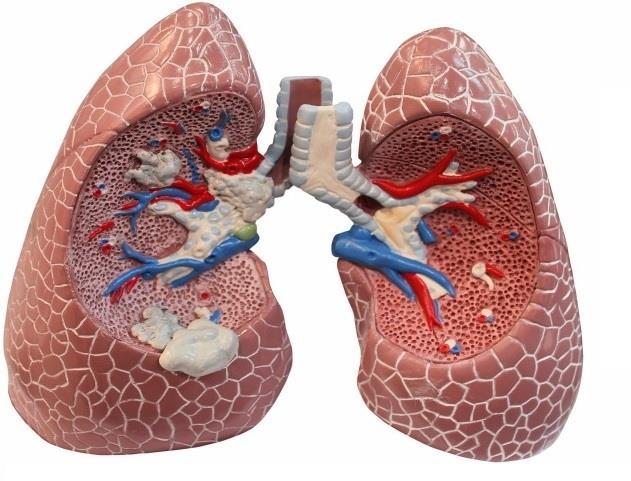 2 TEORETICKÉ POZADÍ Chronická (= dlouhotrvající) obstrukční pulmonální (= plicní) nemoc (dále jako CHOPN) Obstrukční plicní nemoc je chronické onemocnění, které se projevuje expektorací sputu