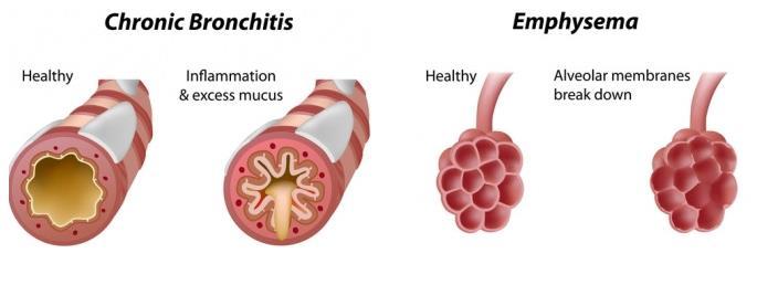 2 Emfyzém Emfyzém neboli rozedma plic je onemocnění, při kterém dochází k poškození a úbytku plicní tkáně. Ztráta plicní elasticity vede k uvěznění vzduchu v plicích.