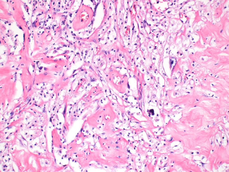 A B Obr. 10. Hodnocení odpovědi na chemoterapii u HGCS (CRS chemotherapy response score ).