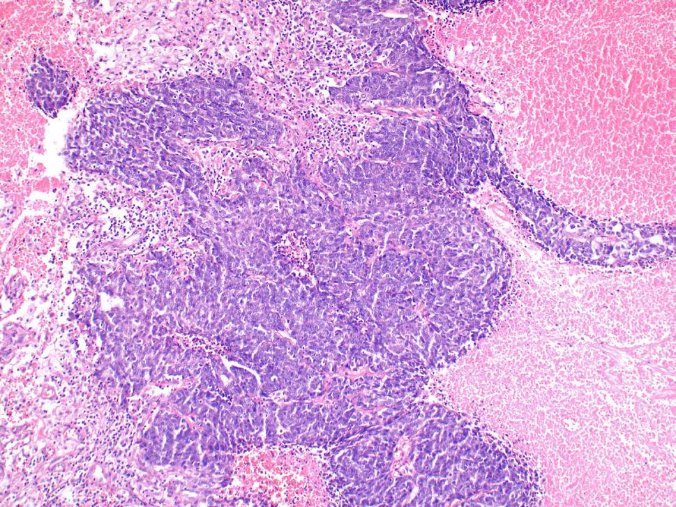 S-BTO / neinvazivní LGSC LGSC M kód HGSC M-BTO / atypicky proliferující mucinózní nádor Mucinózní karcinom E-BTO / atypicky proliferující endometroidní nádor Endometroidní karcinom Světlobuněčný