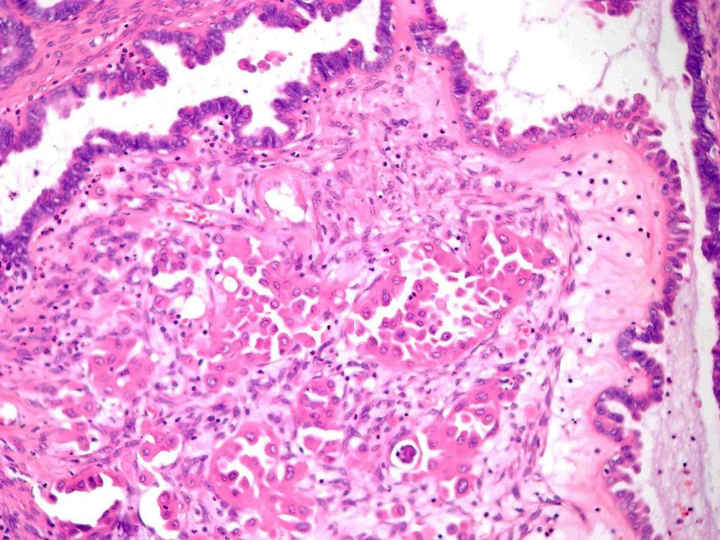 2014 je zmínka, že: Velmi malá část HGSC jsou intracystické nádory postrádající zjevnou invazi, které byly v minulosti chybně diagnostikovány jako S-BTO (obr. 7).