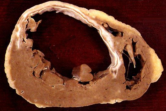 anterior Aneurysma