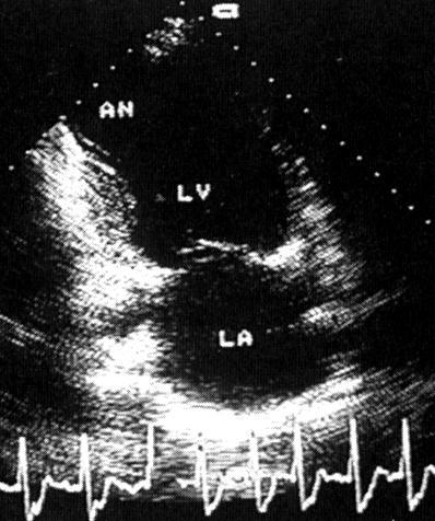 aneurysma