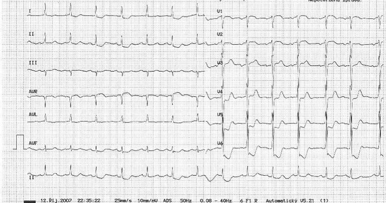 Non-STEMI