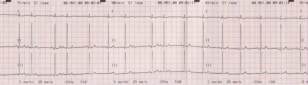 3. Jaký je vztah P-QRS? 3.