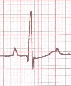 Amplitudy EKG R P T