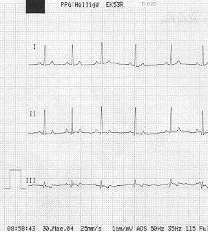 Analýza EKG Pro analýzu EKG je důležité vědět, jak je přístroj EKG kalibrován.