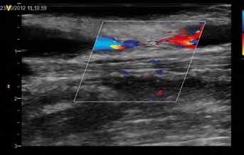 Obr. 2 Obr. 3 Obr. 2. Sonografický obraz stenózy odvodné žíly nativního dialyzačního zkratu Fig. 2. Ultrasonography image of stenosis of the draining vein of native hemodialysis fistula Obr. 3. Sonografický obraz konce sheathu v lumen žíly nativního dialyzačního zkratu Fig.