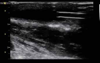 5. Sonografické zobrazení vodiče před stenózou Fig. 5.