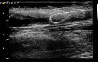 Po provedení PTA jsme zhodnotili šíři lumina žíly v intervenovaném místě, byla 3 mm, a změřili jsme průtok v a. brachialis, byl 1162 ml/min.