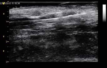 Obr. 6 Obr. 7 Obr. 6. Sonografický obraz insuflovaného balónkového katétru se zúžením v místě rigidní stenózy žíly Fig. 6. Ultrasonography image of inflated balloon catheter with distinct waist due to tough stenosis of the vein Obr.