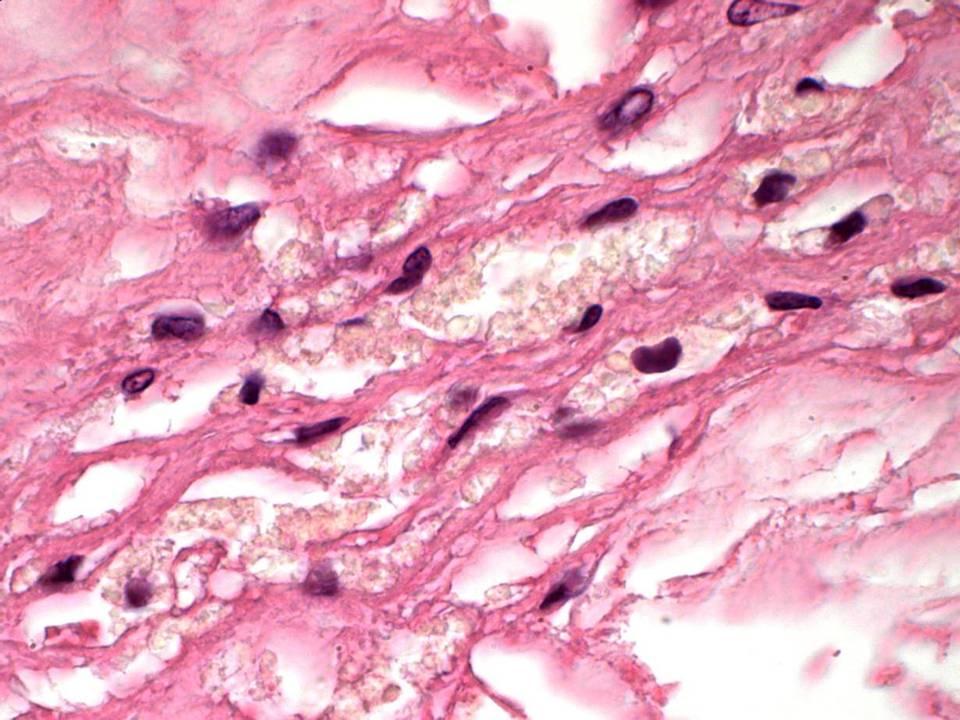 Ateromový plát pěnité buňky (lipofágy) 2 2 jádra
