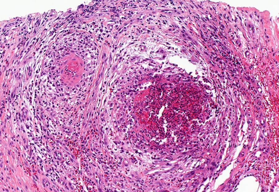 Polyarteriitis nodosa 2 3 2 3 3 3 lumen cévy