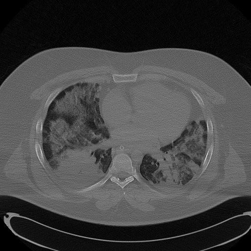 mozkový absces) sepse metabolické poruchy (hypoglykémie) cerebrální