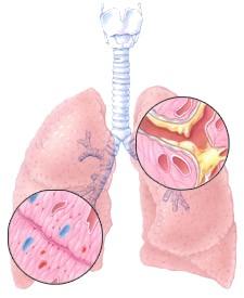 org/lung_disease/copd/nut