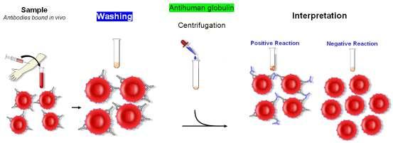 18. POUŽÍVANÉ METODY V IMUNOHEMATOLOGII Obrázek č. 12: Postup PAT, www.wilkipedia.org/wiki/coombs_test 1. Vzorek - navázané protilátky in vivo 2. Promytí 3. AGH 4. Centrifugace 5.