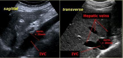 Vena cava inferior začátek: soutok vv.