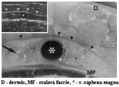 Vena saphena magna confluens venosus subinguinalis valvula terminalis + preterminalis v.s.m. accessoria ant.