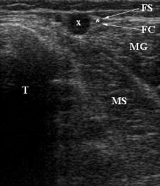 Vena saphena parva valvula terminalis + preterminalis v.s.p. accessoria superficialis extensio cranialis venae saphenae parvae (dříve v.