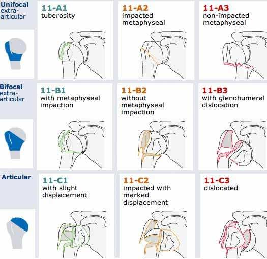 Zlomeniny proximálního humeru RTG (AP+TT), případně CT AO klasifikace
