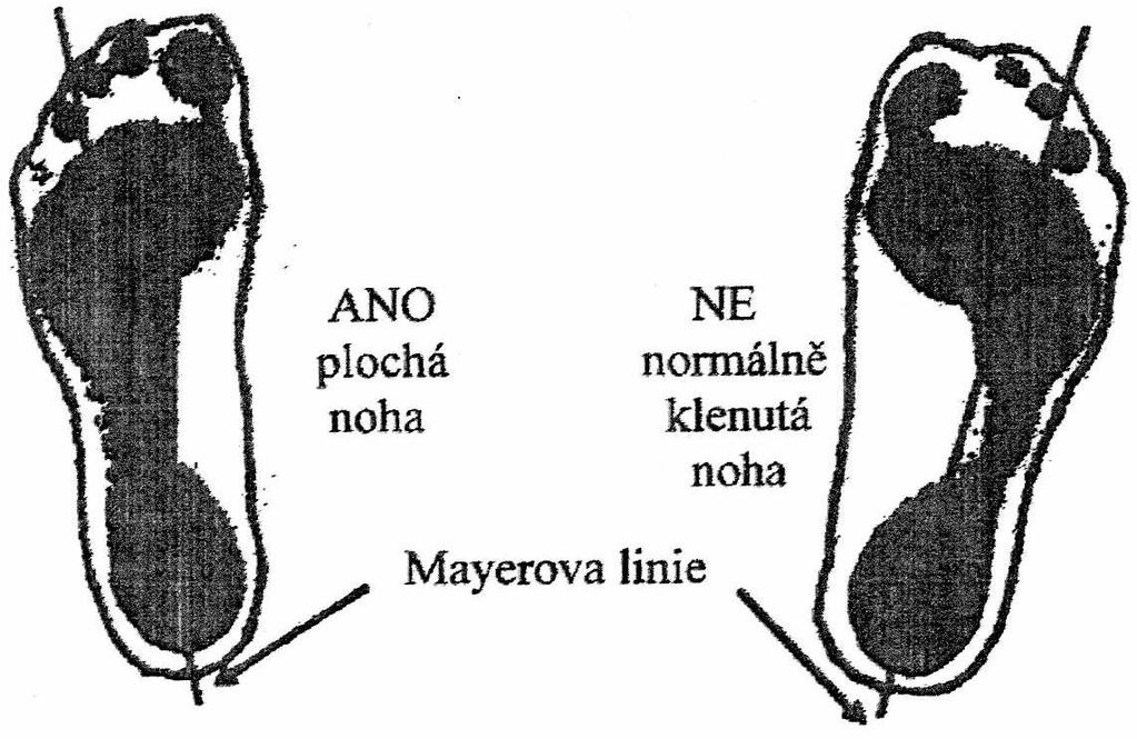 8.3.1.3 Hodnocení plantogramu metodou podle Mayera (Purgarič, 1994) Z hlediska náročnosti vyhodnocování stavu klenby nohy je Mayerova metoda nejjednodušší z uvedených plantografických metod.