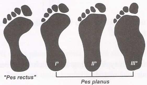 6 Metoda hodnocení plantogramu vizuální škálou (Kapandji, 1985, Dungl, 1989) Princip