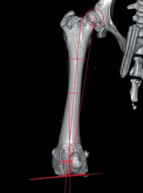 S ohledem na nemožnost stanovení přesné femorální anteverze z RTG snímků bylo provedeno v návaznosti CT vyšetření a měření zopakováno na přesně