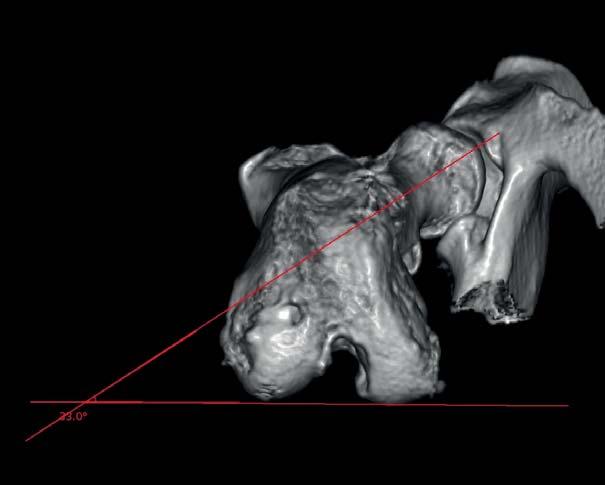 Úhel anteverze (femoral torsional angle, FTA) byl vpravo 33 (vlevo 28 ), což bylo hodnoceno jako mírná interní torze distální stehenní kosti (referenční
