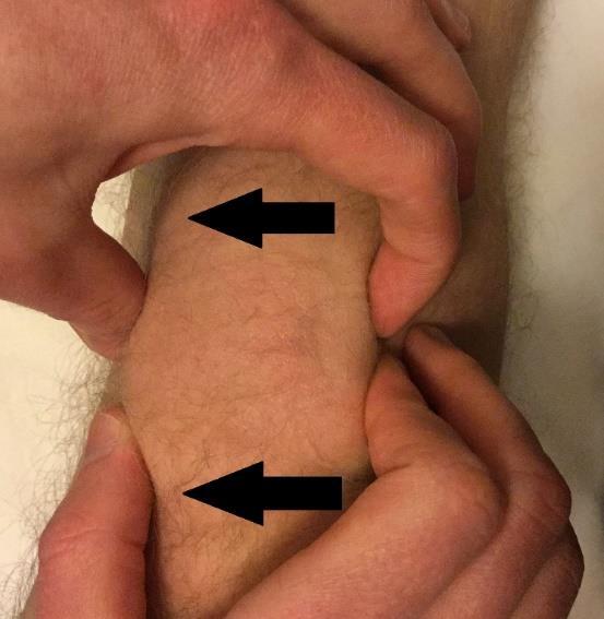 Postup: uchopíme kožní řasu v místě jizvy mezi palce, protisměrným lehkým tlakem dosahujeme za pomocí protažení měkkých tkání předpětí, v něm setrváváme a čekáme