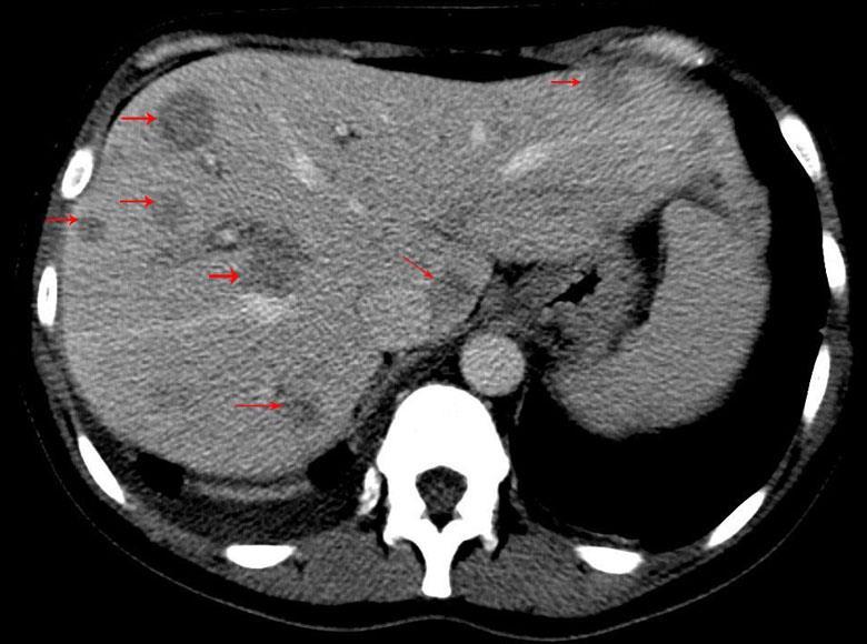 absces (histoplasmóza,