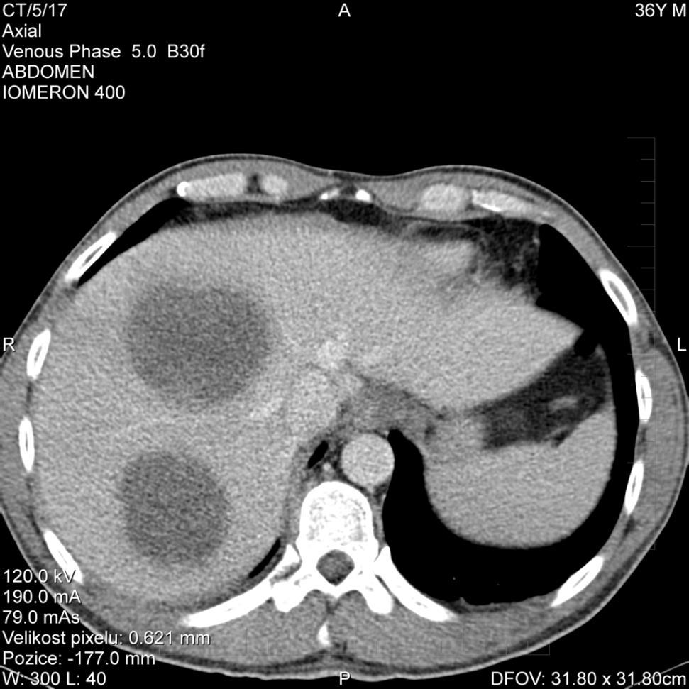 CT - nález 2 objemných abscesů (o průměru 10 a 11 cm) v pravém jaterním laloku.