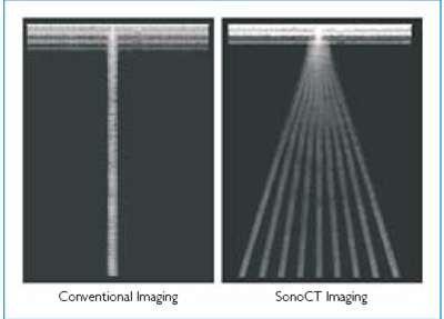 Real-time compound imaging Dochází k vychylování UZ paprsku, čímž vzniknou tomografické obrazy z různých úhlů pohledu (redukce
