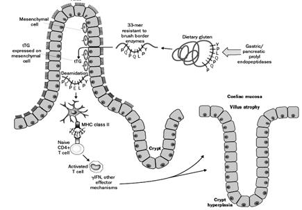 ONEMOCNĚNÍ 19-mer PEPTID Zonulin CÉLIAKIE ATROFIE KLKŮ POŠKOZENÍ SLIZNICE TENKÉO STŘEVA CD4+ T-BUŇKA PROJEVY MALABSORPČNÍO SYNDROMU T2-BUŇKA T1-BUŇKA ZÁNĚTLIVÁ ODPOVĚĎ 63 ODPOVĚĎ NA BEZLEPKOVOU DIETU