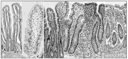 BIOPSIE TENKÉO STŘEVA - KLASIFIKACE SOUČASNÝ PROTOKOL STANOVENÍ PROTILÁTEK (EVIDENCE - BASED)