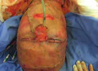 Kritické popálení a inhalační trauma směsí červeného a bílého fosforu Epstein-Barr virus EBV).