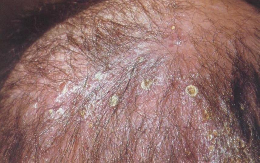 25 Při diagnostice má hlavní význam přítomnost původce v nativním preparátu a kultivace. Vhodné je i vyšetření Woodovou lampou. (Braun-Falco et al. 2001) Favus (Tinea favosa) Favus (viz Obr. 3.