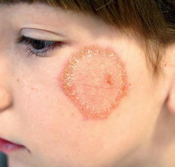 27 Obr. 3.3 Tinea faciei Převzato z: http://www.zdn.cz/ Klinický obraz je pestrý podle druhu dermatofytů.