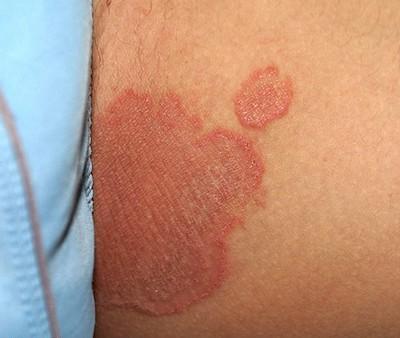 28 3.3.4 Tinea inguinalis (Tinea cruris) Tinea inguinalis (viz Obr. 3.5) je dermatofytické onemocnění třísel u mužů, vzácně u žen.
