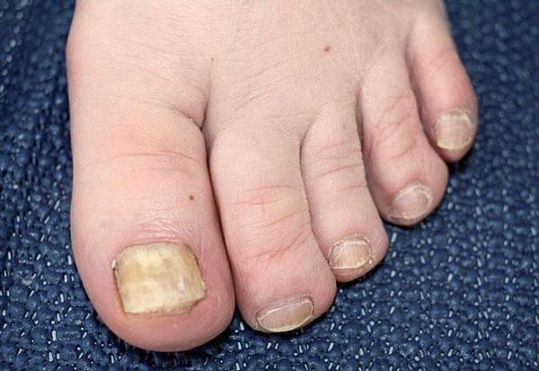 32 eroze a ragády mezi prsty. Další komplikací může být kontaktní alergie, vyvolána složkami antimykotik. (Braun-Falco et al.