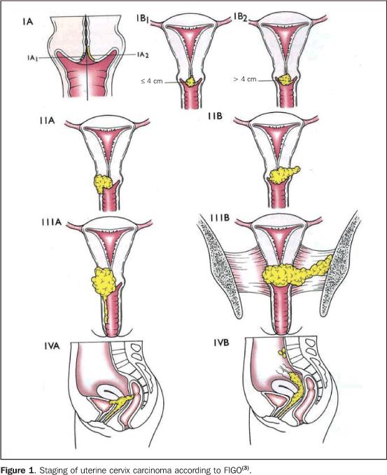 Histopatologie: Spinocelulární karcinom,