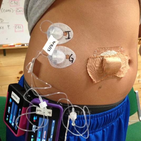 Bionic Pancreas Projekt Massachusetts General Hospital and Harvard Medical School, Boston Dual-hormon (insulin, glukagon) uzavřená