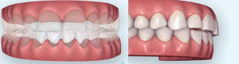 Obr. 3: Původní klinická situace. Obroušené frontální zuby a kompenzatorní extruze. Obr. 4: Klinická situace 9 měsíců po fóliové ortodontické léčbě.