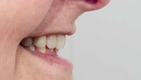 Obr. 8 Obr. 9 Obr. 10 Obr. 11 Obr. 12 Po detailní konzultaci bylo rozhodnuto, že pacientka nejprve podstoupí krátkou ortodontickou léčbu.