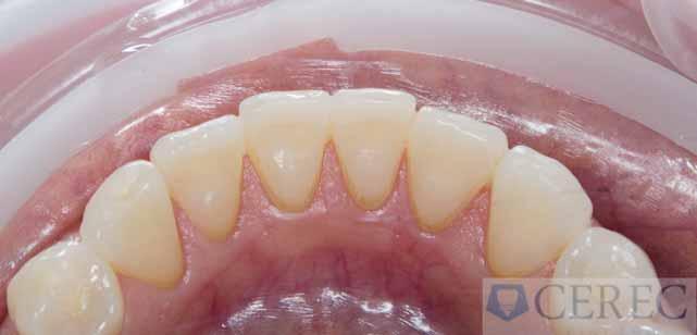 Hlavním cílem ortodontické léčby bylo intrudovat řezáky do jejich původní pozice a vytvořit prostor pro bezpreparační fazety.