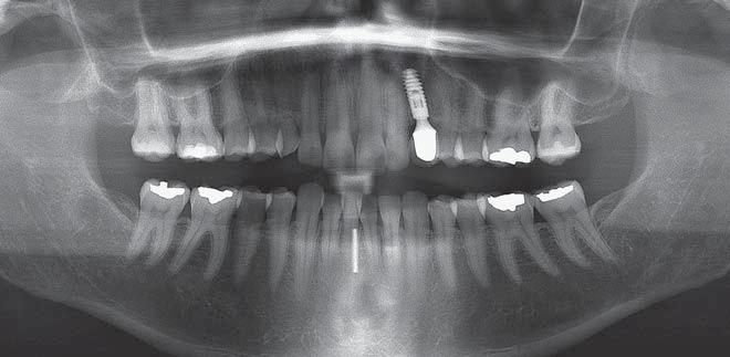 Využití úzkých implantátů Autor: Dr.