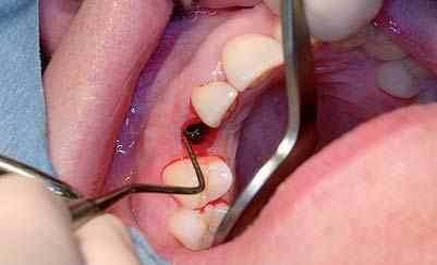 po implantaci.. Procedura Atraumaticky jsem odstranil zub 53; meziální a distální papila zůstala intaktní.