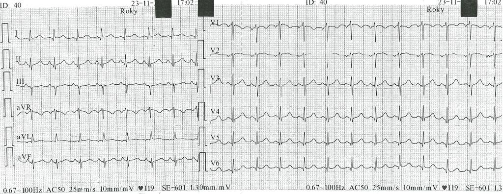 EKG při