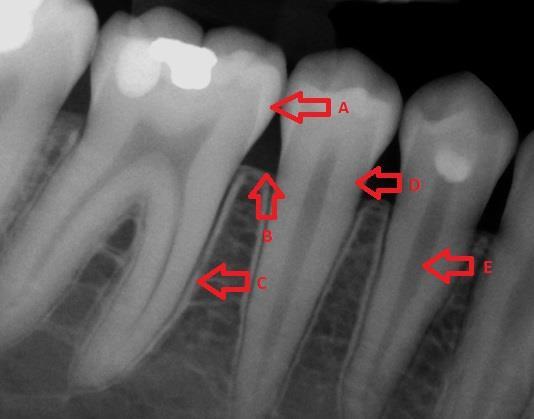 Periodontální štěrbina se na RTG snímcích jeví jako projasnění, jako tmavý úzký souvislý prostor mezi kořenem zubu a vlastní alveolární kostí, periodontální vazy, které ji vyplňují nejsou na RTG