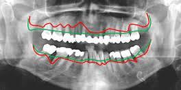 Resorpce alveolární kosti Nezastupitelnou hodnotu má rentgenový snímek, především v zobrazení hlubší parodontální tkáně alveolárního výběžku tvořeného alveolární kostí.