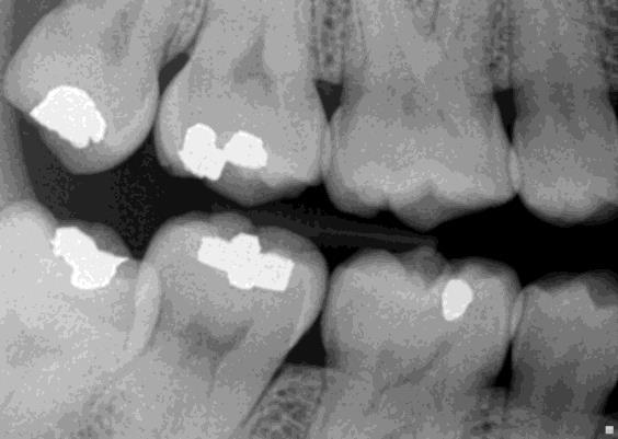 Marginální projekce Limbální projekce (Obrázek 13). V praxi se používá méně často. Centrální paprsek směřuje do oblasti krčku zubů. Snímek zobrazuje marginální parodont a korunky.